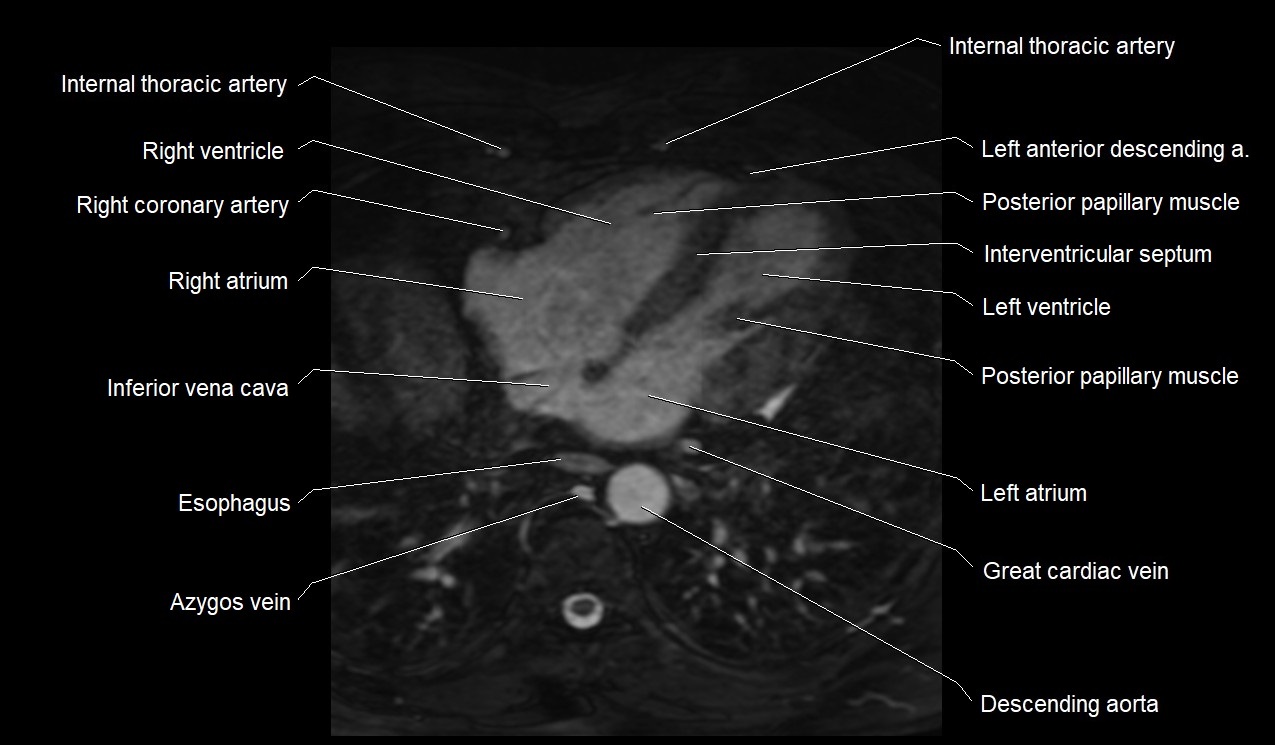 MRI heart coronary arteries and coronary veins anatomy axial image 32.jpg